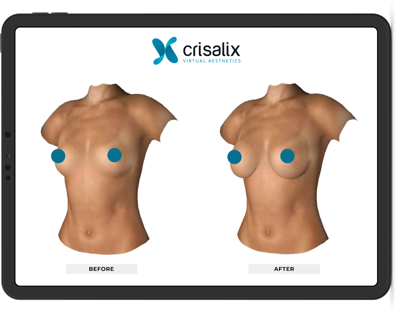 Crisalix: simulatore di chirurgia estetica